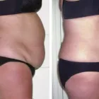 Business 3 image LASER LIPO GOLD Laser Treatment in Krugersdorp GP