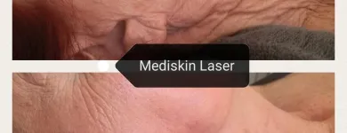Maatskappy 1 beeld MEDISKIN LASER CLINIC Young Nails in Pretoria GP