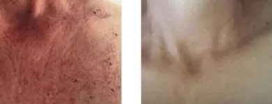 Maatskappy 2 beeld MEDISKIN LASER CLINIC Young Nails in Pretoria GP