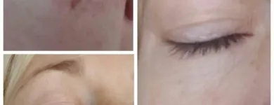 Maatskappy 3 beeld MEDISKIN LASER CLINIC Young Nails in Pretoria GP